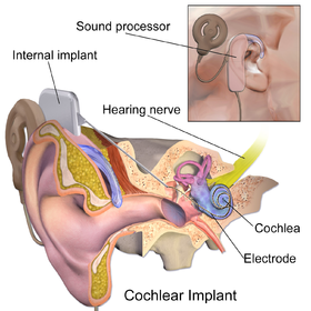 کاهش شنوایی و کاشت حلزون و نقش کاردرمانی در کودکان کم شنوا
