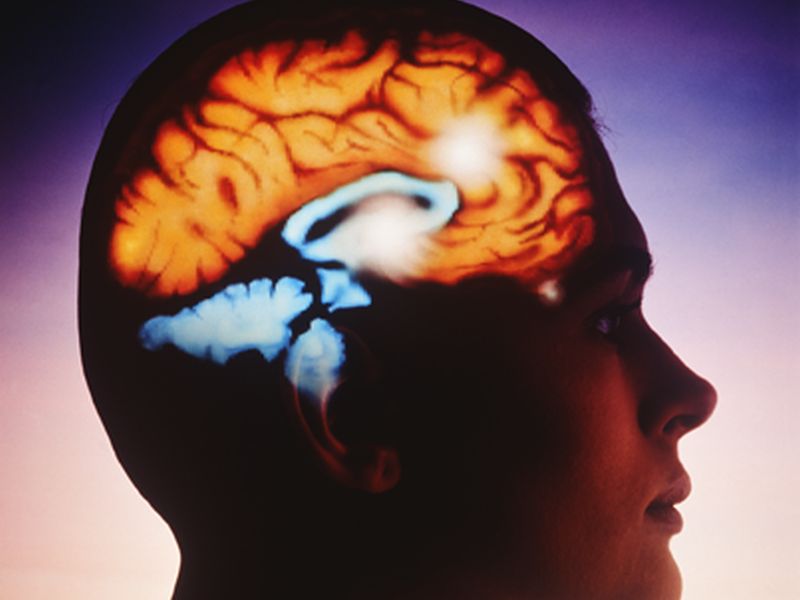 اثربخشی گفتاردرمانی در بیماران با سکته مغزی